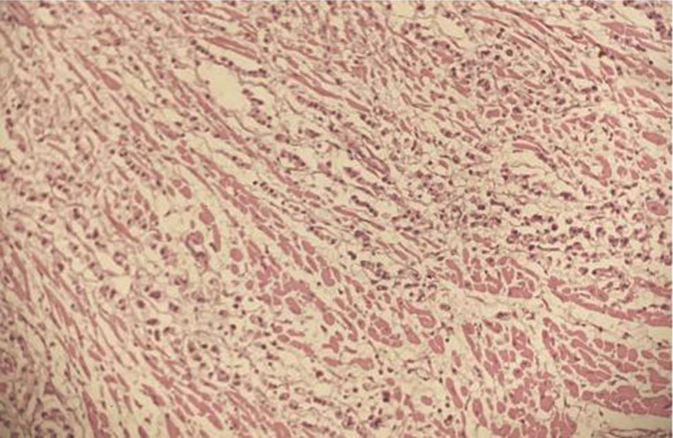 Fig. 2 H&E section from left ventricular wall showing metastatic deposits of signet ring cell carcinoma (200×). H&E, hematoxylin and eosin staining.