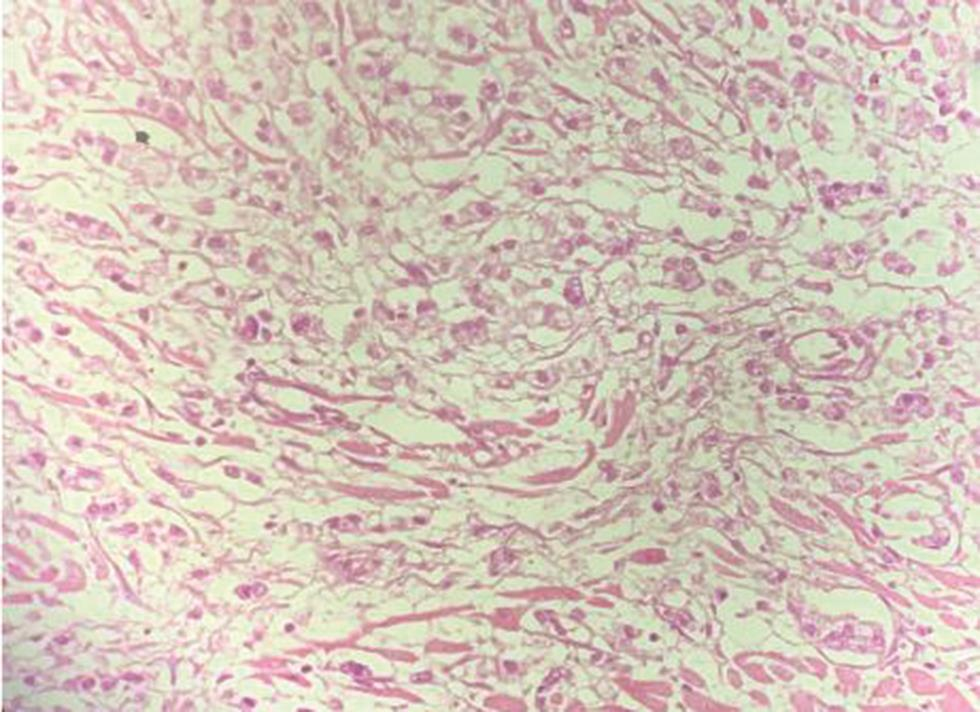 Fig. 3 H&E section from left ventricular wall shows metastatic deposits of signet ring cell carcinoma (400×). H&E, hematoxylin and eosin staining.