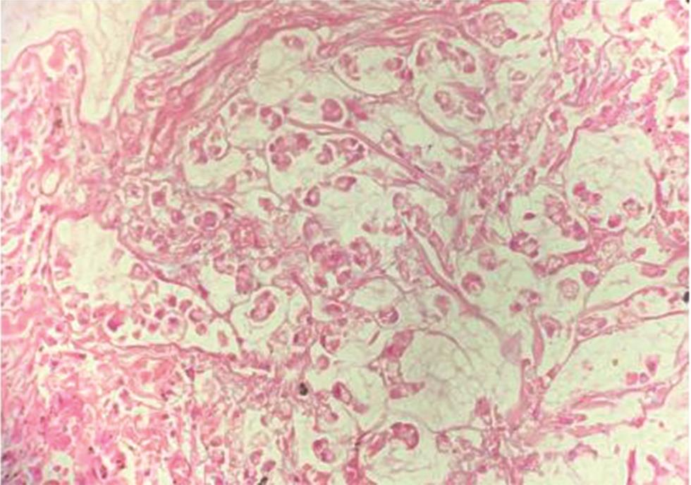 Fig. 4 H&E sections from lung showing signet ring cells at high power (400X). H&E, hematoxylin and eosin staining.