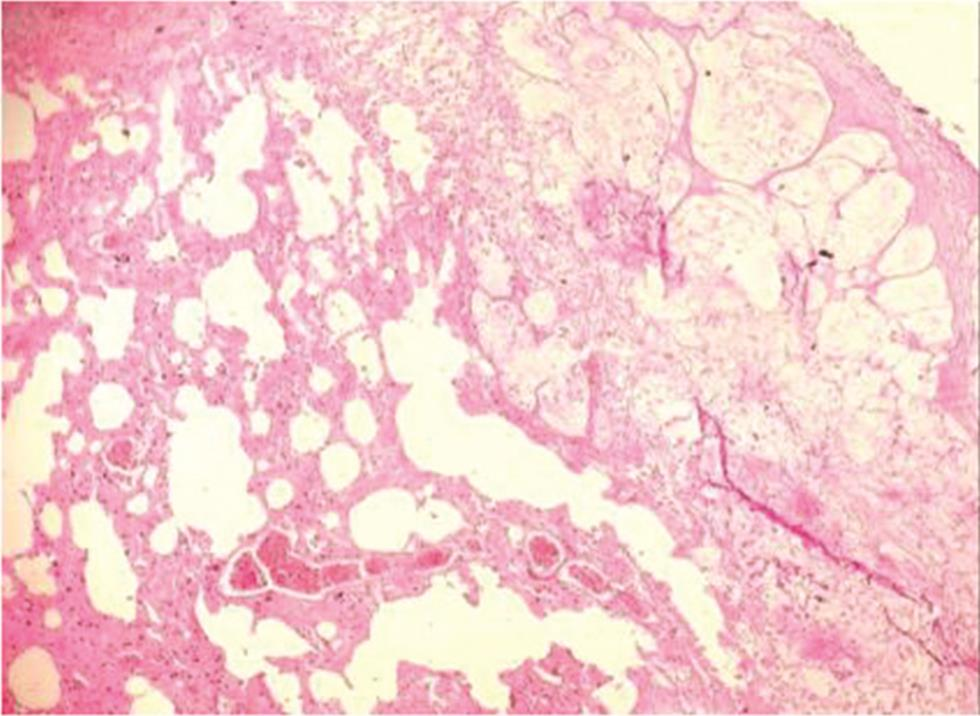 Fig. 5 H&E sections from lung showing metastatic deposit of signet ring cell carcinoma (200X). H&E, hematoxylin and eosin staining.
