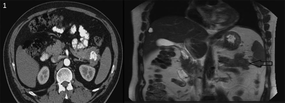 Fig. 1 Radiological imaging of the calcified pancreatic mass.