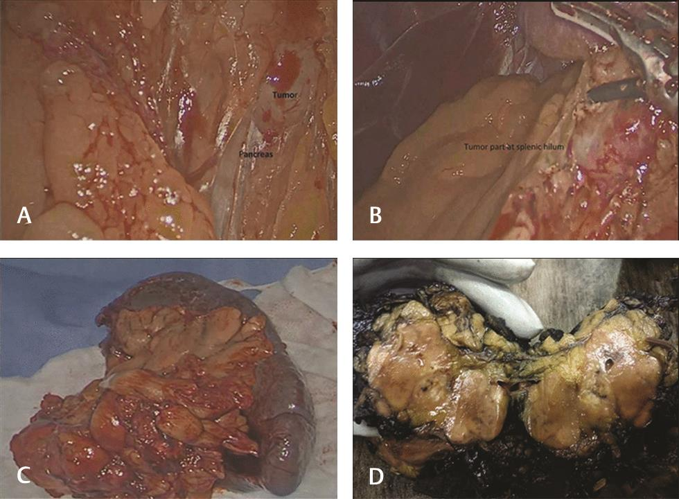 Fig. 2 (A, B) Intraoperative pancreatic tumor adherent to splenic hilum. (C) Distal pancreatectomy with spleen. (D) Gross image of the pancreatic mass with tan brown, glistening and myxoid surface.