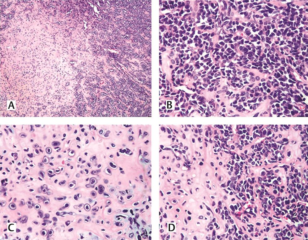 Fig. 3 (A) Hematoxylin and eosin stain, 40 X, dimorphic tumor with round blue cells and interspersed pink cartilage. (B) Hematoxylin and eosin stain, 400X, poorly differentiated small round blue cells with hemangiopericytomatous pattern. (C, D) Hematoxylin and eosin stain, 400X, atypical hyaline cartilage with juxtaposed small blue cells.