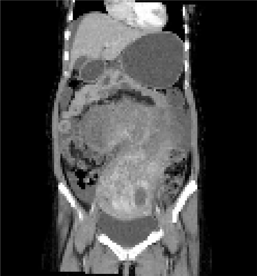 Fig. 1 CECT scan showing huge abdominopelvic mass which is hetrogenous with omental adhesions CECT, contrast-enhanced computed tomography.