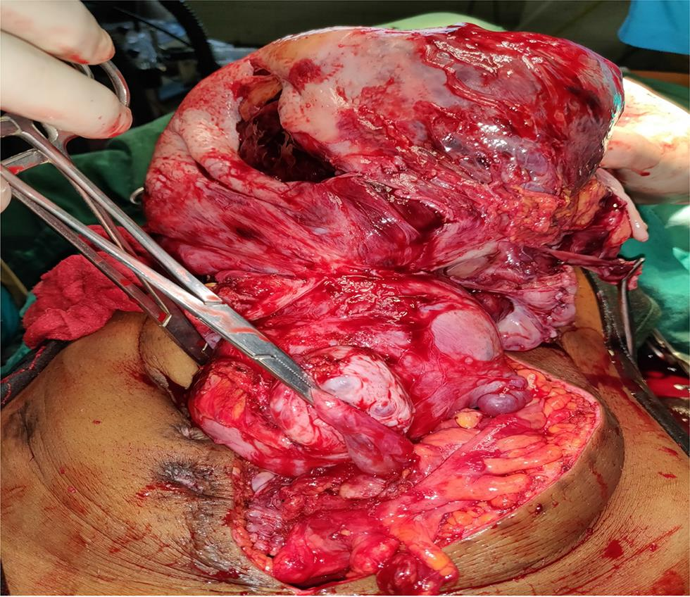 Fig. 2 (Intraoperative) Uterus with mass from fundus with B/L ovaries with sigmoid colon lie anteriorly and omental adhesion after adhesiolysis.