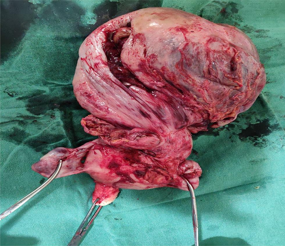 Fig. 3 Specimen showing leiomyosarcoma mass getting twisted from fundus with necrotic areas and B/L adnexa.