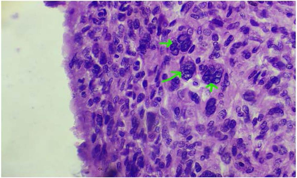 Fig. 4 Hyperchromatic and giant nucleus.