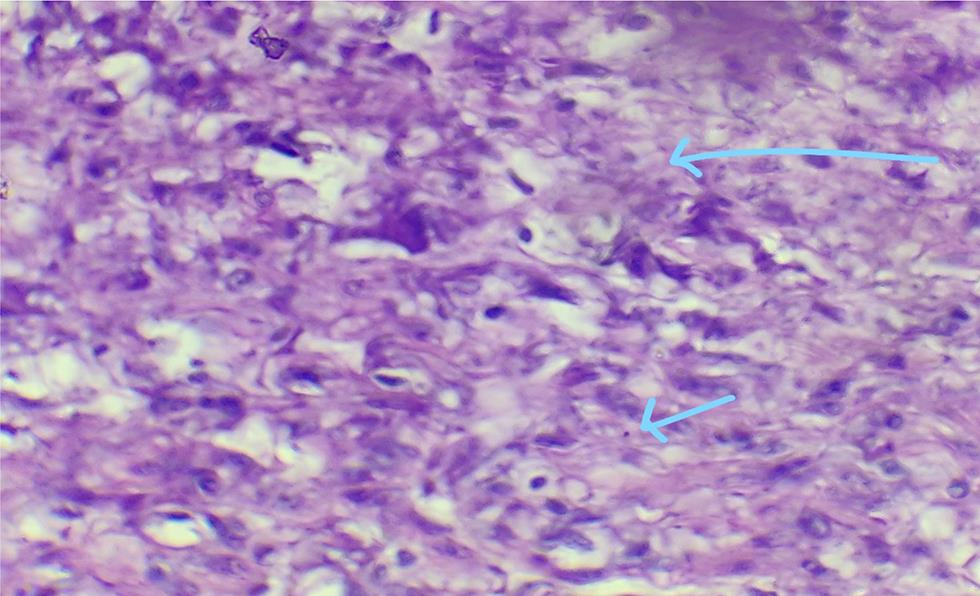 Fig. 6 Areas of necrosis (hallmark of leiomyosarcoma).