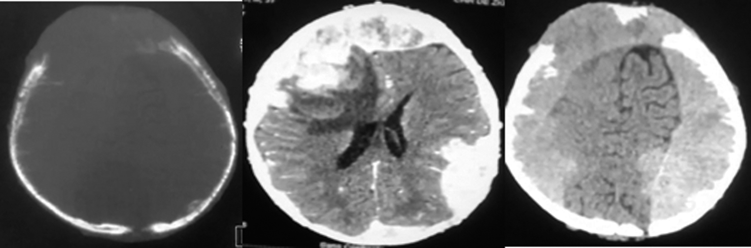 Fig. 2 Cerebral computed tomography scan showing a lytic, right frontoparietal tissular process heterogeneously enhanced after injection of contrast material with bilateral hemispherical predominantly extradural endocranial extension with dural invasion and intraparenchymal extension and significant perilesional edema.