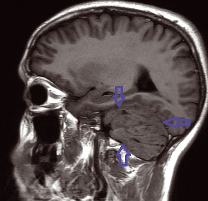 Fig. 1 Left mass cerebellum in T1-weighted sequence MRI.