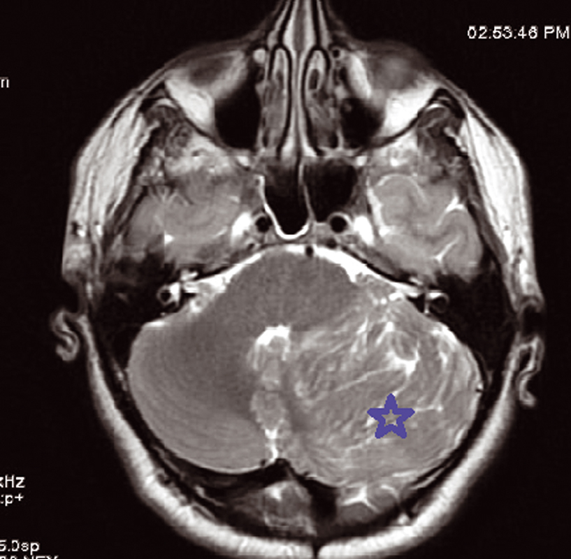 Fig. 2 Hyperintensity intralesional on T2 sequence MRI showing the typical striated or tiger-striped folia pattern.