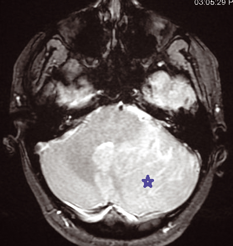 Fig. 3 Hyperintensity intralesional on diffusion sequence MRI.