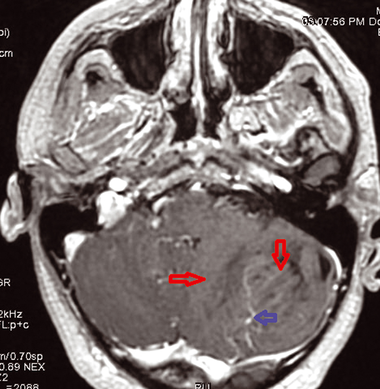 Fig. 4 Absence of enhancement intralesional with venous abnormalities on T1 + Gado sequence MRI.