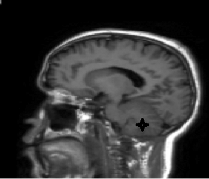 Fig. 5 Right cerebellum hemisphere normal in T1-weighted sequence MRI.