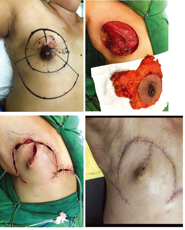 Fig. 2 Surgical steps on performing horse-shoe flap using outer circle adjacent tissue as donor flap.
