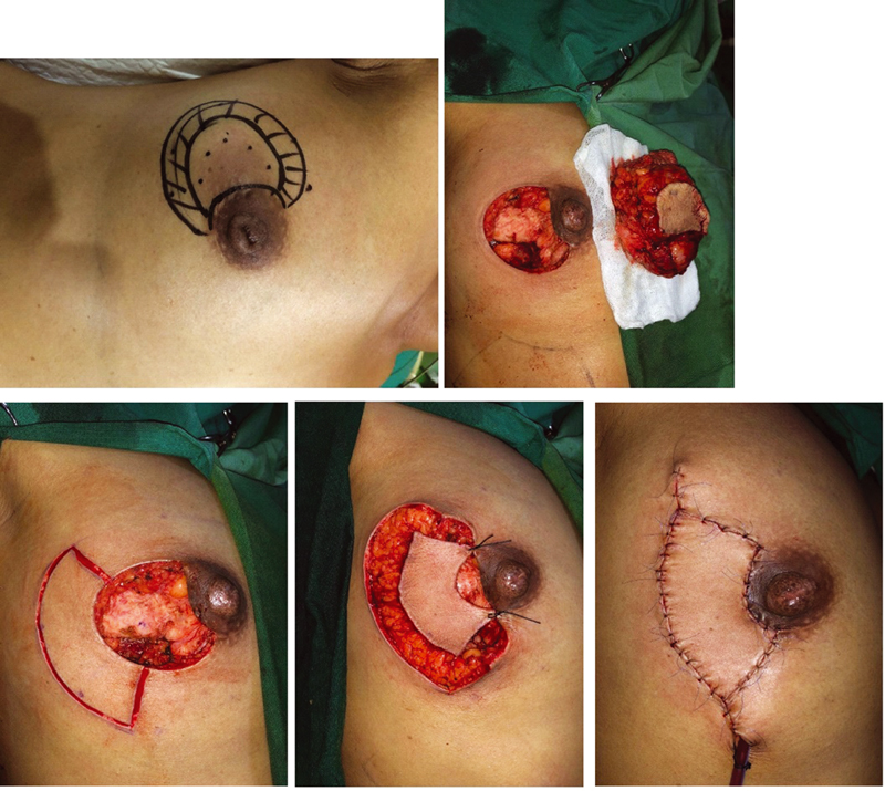 Fig. 3 A 45-year-old patient with small phyllodes tumor on her right breast underwent horse-she flap reconstruction using 120-degree angle from the center circle and 2-cm defect radius.