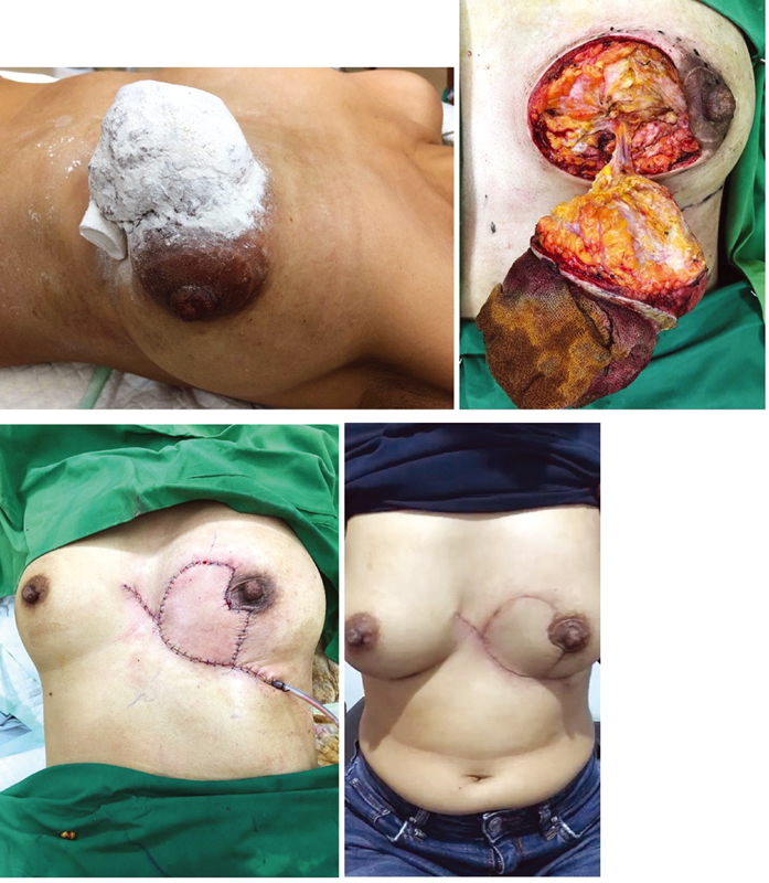 Fig. 4 A 36-year-old patient with a bigger phyllodes tumor underwent wide excision and reconstruction with horse-shoe flap, 120-degree angle from the center circle and 4-cm defect radius.