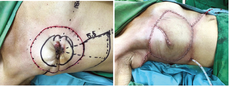 Fig. 5 A 55-year-old patient with invasive breast cancer underwent radical mastectomies with 11-cm diameter of primary defects, 5.5 cm of adjacent tissue radius was used to close the defects using a horse-shoe flap.