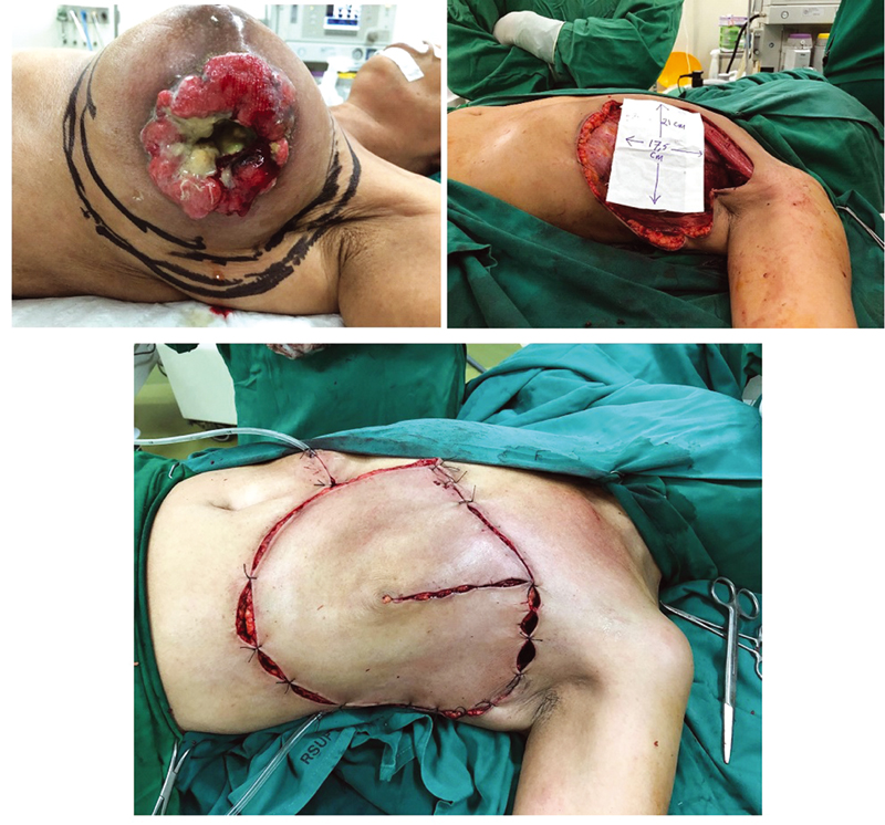Fig. 6 A 52-year-old patient with 21 × 17 cm2 of the primary defect after radical mastectomy underwent a horse-shoe flap using 10 cm of skin outside the defect for closure.