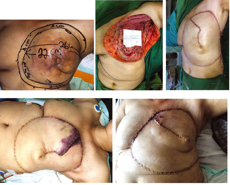Fig. 7 A 55-year-old patient with the largest defect in this study underwent horse-shoe flap using 13-cm adjacent tissue below the defects. Marginal necrotic skins were found after surgery, and reexcision of necrotic skin was necessary, followed by stitching both edges for closure.