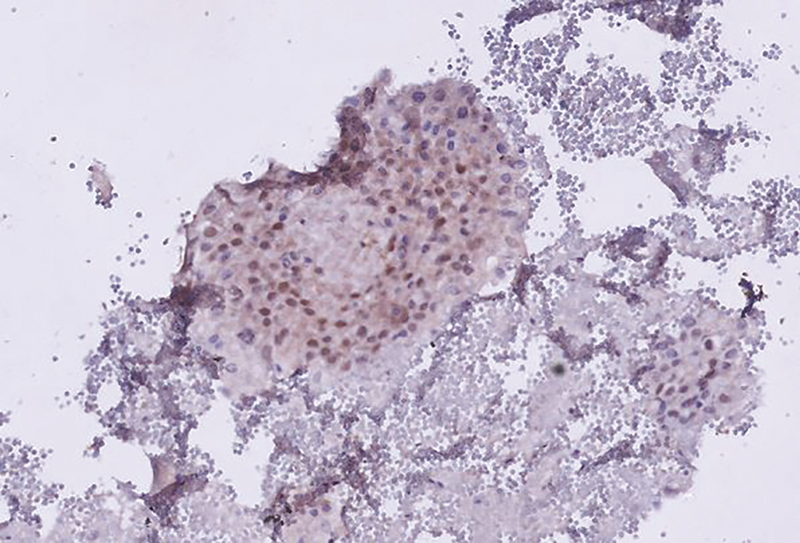 Fig. 2 Immunohistochemistry of cell block prepared from malignant pericardial effusion, suggestive of breast origin by immunohistochemical marker GATA3.