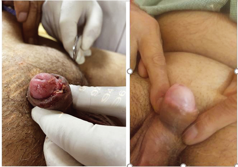 Fig. 2 Penile ulcer at diagnosis and at first follow-up (complete response of primary disease).