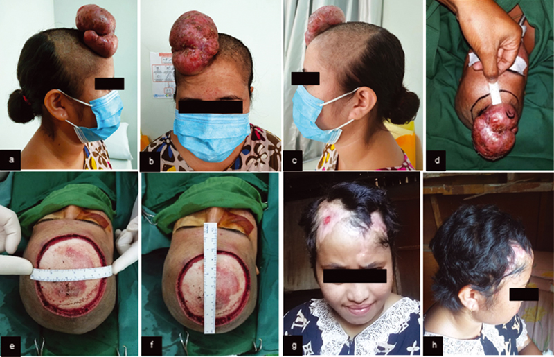 Fig. 1 (A) Preoperative mass clinical features (right lateral view). (B) Preoperative mass clinical features (anterior view). (C) Preoperative mass clinical features (left lateral view). (D) Incision marker of 2 cm distance. (E–F) Clinical features of intraoperative wide excision. (G–H) Six months after wide excision and rotational flap.