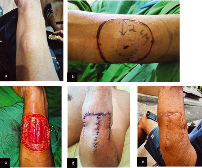 Fig. 2 (A) Preoperative mass clinical picture. (B) Incision marker of 2 cm distance. (C) Clinical features of intraoperative wide excision. (D) Postsurgical resection: day 3. (E) Three months postsurgical resection.