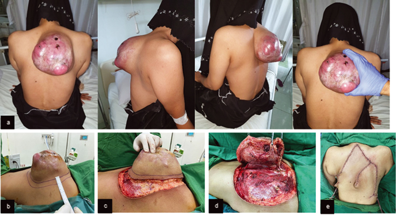 Fig. 3 (A) Preoperative mass clinical picture. (B) Incision marker of 2 cm distance. (C–D) Clinical features of intraoperative wide excision. (E) Post wide excision and flap reconstruction.