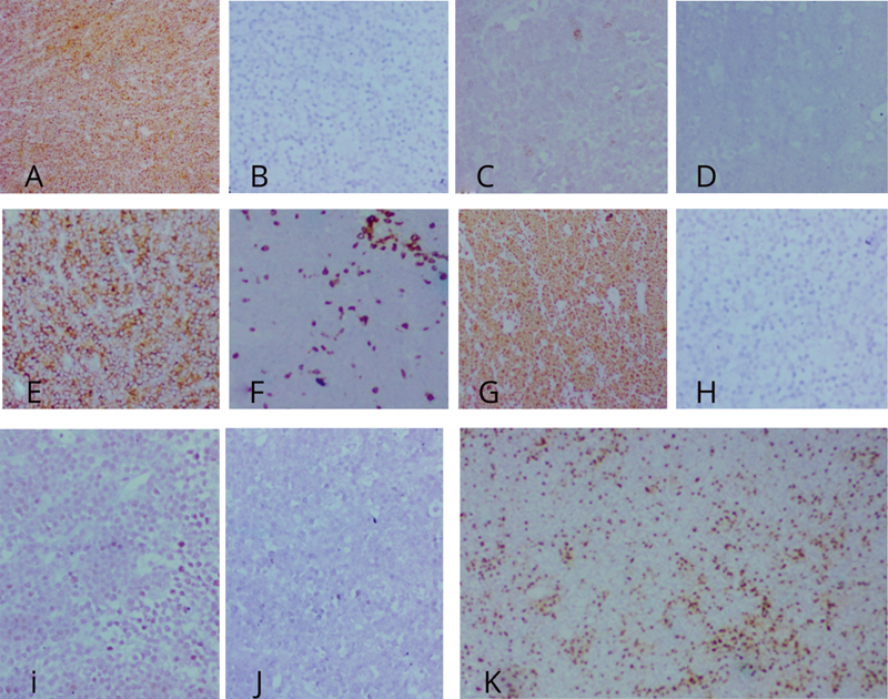 Fig. 2 Immunohistochemistry immunoreactivity of tumor cells shows positivity for leukocyte common antigen (A) and negative for vimentin (B), CD99 (C), and cytokeratin (D). Immunoreactivity for CD 20 (E) is bright and diffuse, while CD 3 (F) is seen highlighting only the background T cells. Ki 67 proliferative index (G) is almost 100%. These features imply a high-grade B cell-derived lymphoma. Immunonegativity for Tdt (H), Alk protein (I), and cyclin D1 (J) rule out close differentials. Strong reactivity for Bcl2 (K) hints toward the diagnosis of high-grade B cell lymphoma as Burkitt lymphoma is typically negative or weakly positive for Bcl2.