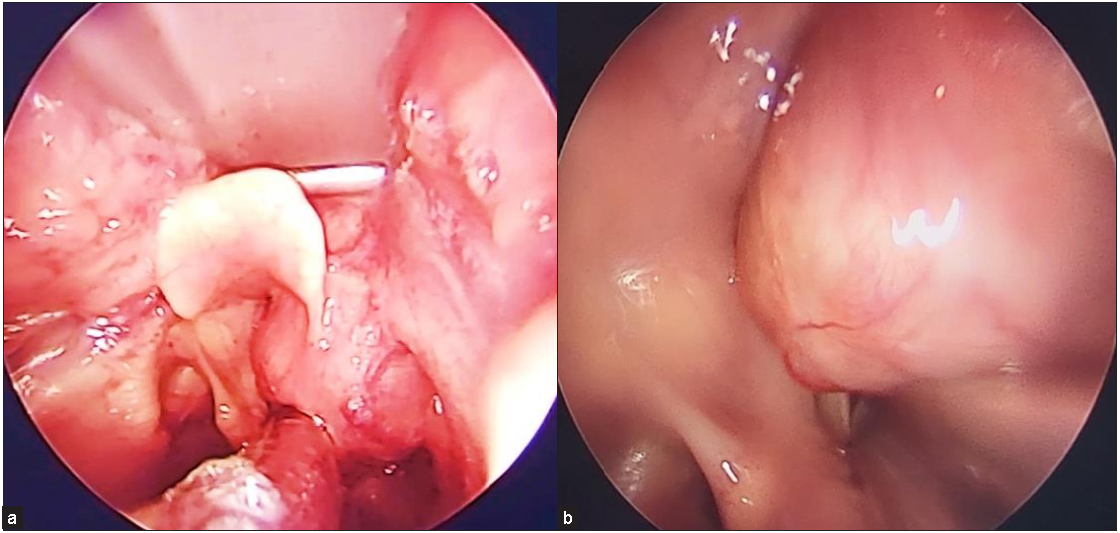 (a) Direct laryngoscopy shows a supraglottic mass. (b) The mass has smooth submucosal swelling and regular surface. No ulcerations were noted.