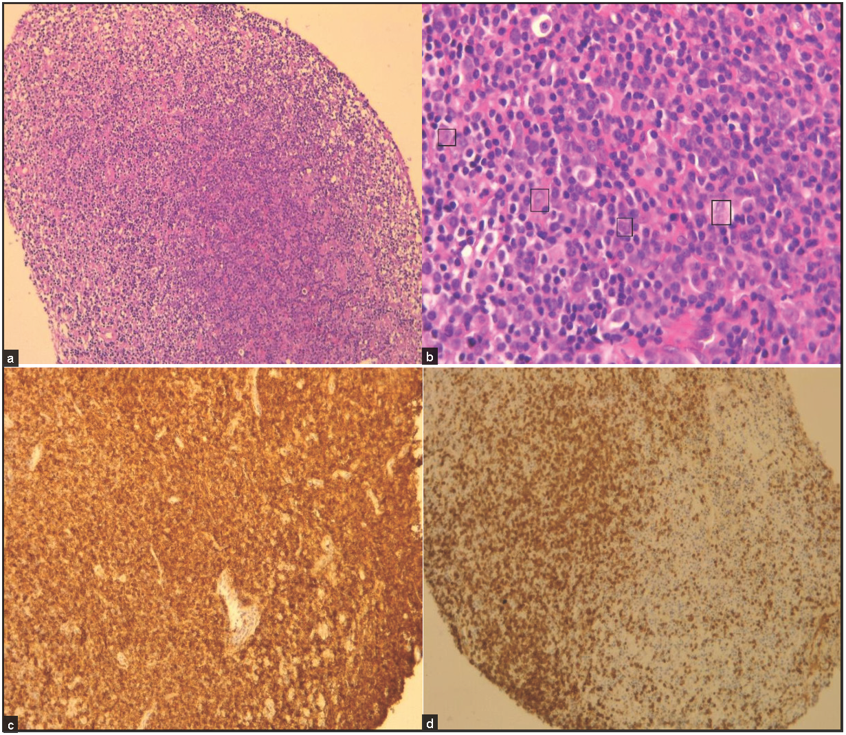 (a, b) Infiltrate of small mature appearing lymphocytes, abundant histiocytes, and large centroblasts and immunoblasts (black square) dispersed throughout the mucosa (a: microscopic magnification x100, b: microscopic magnification x400). Neoplastic cells stained positive for CD20 (c) and CD3 (d).