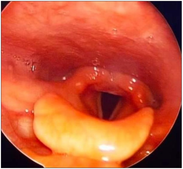 Post therapeutic indirect laryngoscopy with no evidence of residual laryngeal lymphoma.