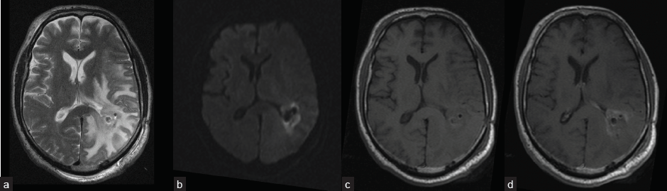 Contrast-enhanced MRI of the brain after sPDT: (a) T2-increase of perifocal edema area; (b) DWI (b 1,000) – diffusion restriction in the intervention area; (c) T1, before contrast - slight increase of signal intensity in the intervention area; and (d) post-contrast T1 – decrease of contrast agent accumulation in the intervention area.