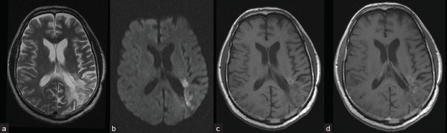 Contrast-enhanced MRI of the brain 6 months after sPDT: (a) T2- reduction of perifocal edema area; (b) DWI (b 1,000) – restriction of diffusion in and to the treatment zone; (c) T1- before contrast – small hyperintense area to the front of the treatment zone; and (d) post-contrast T1 – small area of slight contrast substance accumulation in the treatment zone.