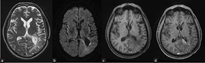 Contrast-enhanced MRI of the brain 14 months after sPDT (recurrence): (a) T2; (b) DWI (b 1000) – small area of diffusion restriction in the exposure area persists; (c) T1, before contrast; and (d) post-contrast T1 – small area of contrast substance accumulation and appearance of a new area of contrast substance accumulation with sizes 38 × 36 × 33 mm.