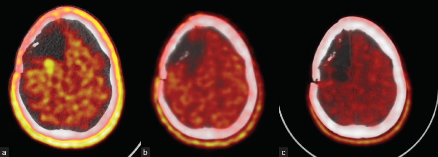 PET/CT with [11C] methionine (a) on the posterior border of the postoperative cyst a zone of increased accumulation = 2.4, size 13 × 24 × 17 mm; (b) 1 month after PDT; and (c) 9 months after PDT – no recurrence.