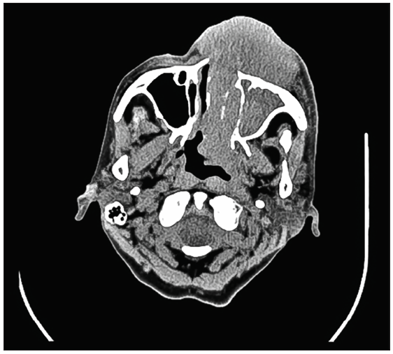 CT scan of the paranasal sinuses with contrast before R-Mini-CHOP chemoimmunotherapy. CT: Computed tomography, R-mini-CHOP: Rituximab and Reduced Dose CHOP (cyclophosphamide, doxorubicin, vincristine, prednisone).