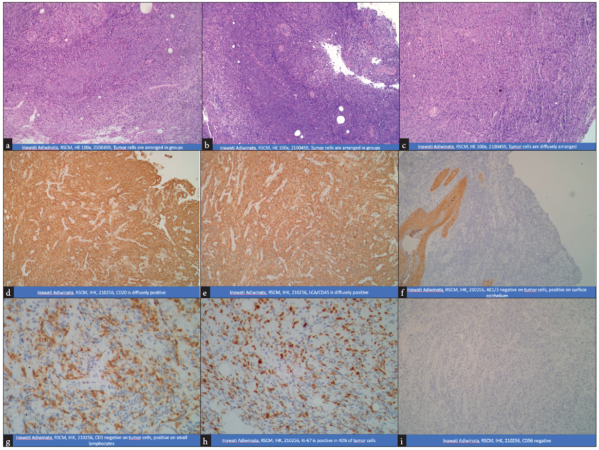 Immunohistochemistry. RSCM: Rumah sakit ciptomangunkusumo (Ciptomangunkusumo Hospital), HE: Hematoxylin and eosin stain, IHK: Imunohistokimia (Immunohistochemistry), CD: Cluster of differentiation, LCA: Leukocyte common antigen.