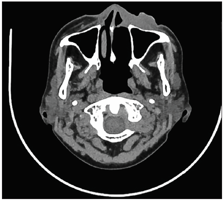 CT scan of the paranasal sinuses with contrast after undergoing the third cycle of R-mini-CHOP chemoimmunotherapy. R-mini-CHOP: Rituximab and Reduced Dose CHOP (cyclophosphamide, doxorubicin, vincristine, prednisone), CT: Computed tomography.