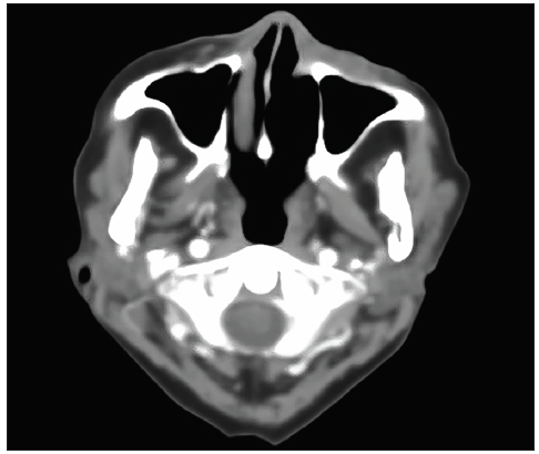 PET-CT scan after finishing the sixth cycle of R-mini-CHOP chemoimmunotherapy. PET-CT: Positron emission tomography-computerized tomography, R-mini-CHOP: Rituximab and Reduced Dose CHOP (cyclophosphamide, doxorubicin, vincristine, prednisone).