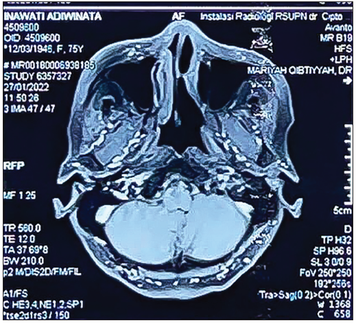 Nasopharyngeal MRI with contrast after 20 cycles of radiation. MRI: Magnetic resonance imaging.