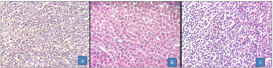 (a) H&E microphotograph showing the granulocytic morphology with interspersed mature myeloid cells, (b) monocytic morphology, and (c) undifferentiated blastic morphology (400x) H&E: Hematoxylin and eosin.