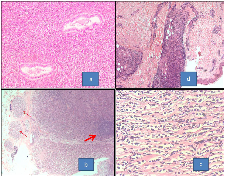 (a) Section of MS from cervix showing the neoplastic cells going around the normal cervical glands (H& E, 100x). (b) MS involving the lymph node showing effacement of nodal architecture with the peripheral localization of remnant follicles (thick arrow) and presence of neoplastic cells in the afferent vessels (thin arrows) (H&E, 40x). (c) Section from paraspinal mass from case of carcinoma breast showing sclerosis and Indian file arrangement of the neoplastic cells (H&E, 400x). (d) MS involving the skin with the presence of neoplastic cells along dermal vessels and periadnexally (H&E, 40x). MS: Myeloid sarcoma, H&E: Hematoxylin and eosin.