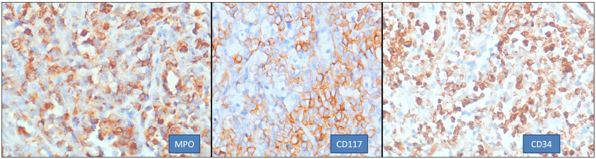 Common immunohistochemistry markers helpful in diagnosis (400x). MPO: Myeloperoxidase.