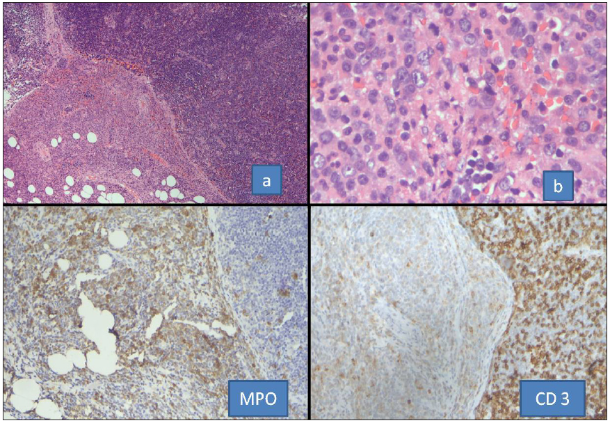 Sections from the case of JAK2-positive MPN presenting as MS in the lymph node. Sections (a, b) show effacement of node with perinodal spread by neoplastic cells. The extranodal cluster is positive for MPO while the nodal neoplastic cells show CD3 expression. MPO: Myeloperoxidase, MPN: Myeloproliferative neoplasm, MS: Myeloid sarcoma, JAK 2: janus kinase 2.