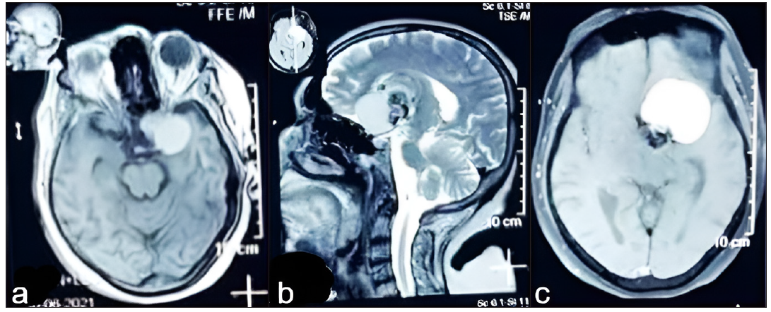 (a) Brain MRI shows a suprasellar with extension to left sphenoid mass that was hyperintense on T1WI axial view, (b) Brain MRI shows a suprasellar with extension to left sphenoid mass that was hyper to mixed signal on T2WI sagittal view, (c) Brain MRI shows a suprasellar with extension to left sphenoid mass with gadolinium enhancement revealed on postcontrast T1WI axial view. MRI: magnetic resonance imaging, T1 weighted image (also referred to as T1WI or the “spin-lattice” relaxation time) is one of the basic pulse sequences in MRI and demonstrates differences in the T1 relaxation times of tissues.