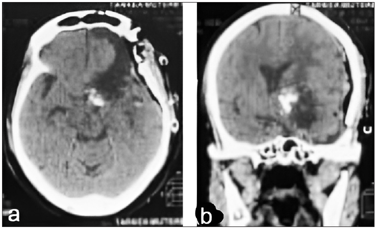 (a) Postoperative brain CT scan axial view showed complete removal of the mass with residual part of calcification, (b) Postoperative brain CT scan coronal view showed complete removal of the mass with residual part of calcification. CT: Computed tomography.