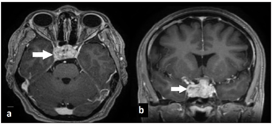 Brain MRI T1 weighted images with gadolinium show invasive pituitary macroadenoma (arrow) without another lesion in the brain parenchyma.