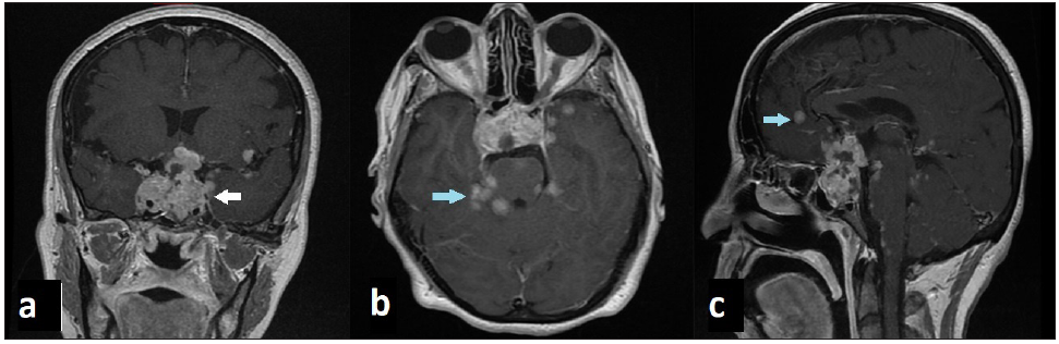 Brain MRI in T1 weighted images with gadolinium shows pituitary carcinoma (white arrow) with brain metastases and meningeal enhancement (blue arrow).